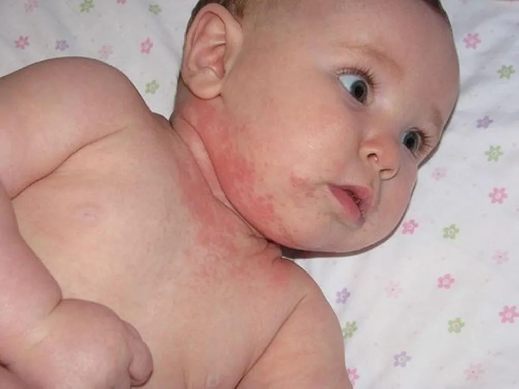 5 أسباب شائعة ل الأكزيما عند الأطفال مع طرق الوقاية والعلاج